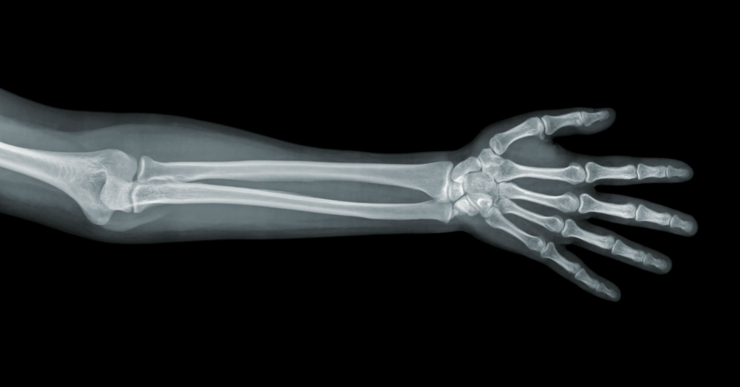 forearm xray showing bones inside